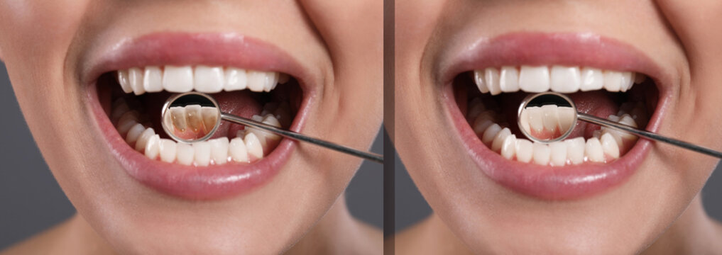Collage with photos of woman before and after professional treatment of dental plaque, closeup. Banner design