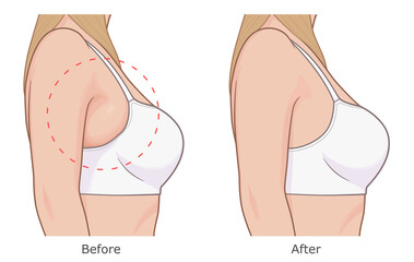 Reduce bra bulge illustration. Woman armpit fat loss vector illustration. Before and after.