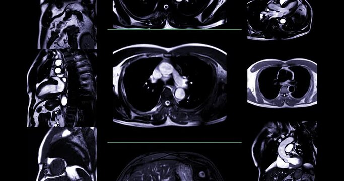 MRI heart or Cardiac MRI ( magnetic resonance imaging  of heart ) showing heart beating for diagnostic heart disease.