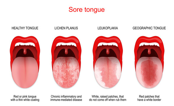Sore or white tongue. comparison of healthy tongue and oral disease