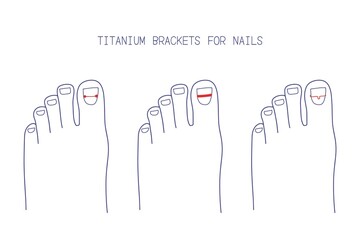 Treatment of ingrown toenail with titanium brackets different types. Hand drawn vector illustration - obrazy, fototapety, plakaty