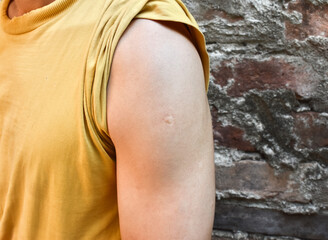 BCG or TB vaccine scar mark at the arm of Asian man.
