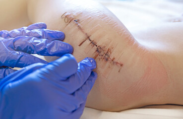 The doctor examines the postoperative sutures on the patient's leg.