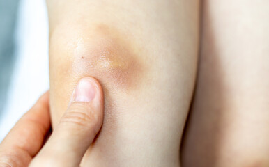 close up of kids legs, little knees, with a big bruise and anti inflammatory cream. mother hand is holding child leg. boy get hurt from fall injuries, medicine, mother care concept.