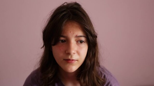 Video of an apathetic and desmotic adolescent, a girl with acne, in her room rests her head on her hand in a gesture of tiredness