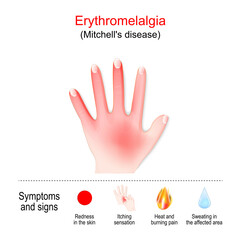 Obraz premium Erythromelalgia. Mitchell's disease in left hand. Symptoms and signs of Erythromelalgia.