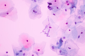View in microscopic of Candidiasis, fungus infection (Yeast and Pseudohyphae form) in pap smear slide cytology and diagnostic by pathologist.Gynecology report and diagnosis medical concept.