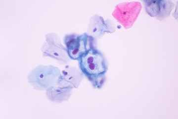 Abnormal squamous epithelial cells view in microscopy.HPV criteria for pap smear slide...