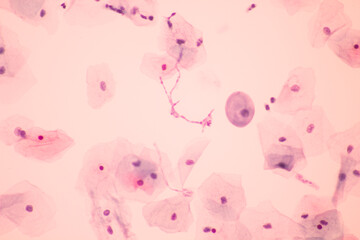 View in microscopic of Candidiasis, fungus infection (Yeast and Pseudohyphae form) in pap smear slide cytology and diagnostic by pathologist.Gynaecology report and diagnosis.Medical concept. - obrazy, fototapety, plakaty