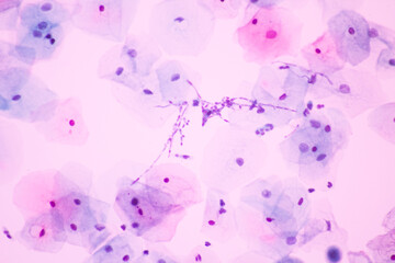 View in microscopic of Candidiasis, fungus infection (Yeast and Pseudohyphae form) in pap smear...