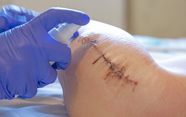 Postoperative dressing, the hands of a doctor in blue gloves, a nurse or a doctor who treats the patient's wound after surgery and disinfects with antibacterial spray to clean the wound after suturing