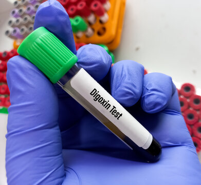 Blood sample for Digoxin test, Digoxin is a medicine called a cardiac glycoside. It is used to treat certain heart problems.