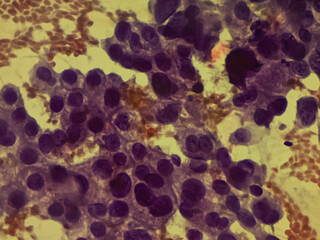 Photomicrograph showing adenocarcinoma of gallbladder. Malignant cell, Gallbladder cancer. high contrast.