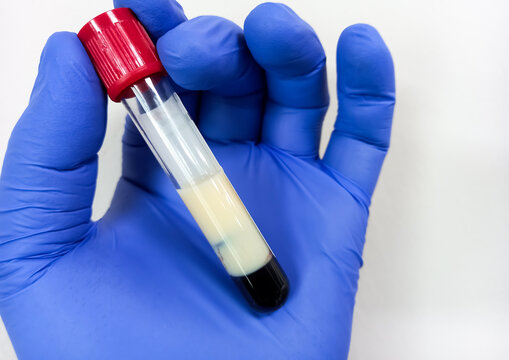 Scientist hold Lipemic blood sample, high Triglyceride contain serum sample. Lipemia