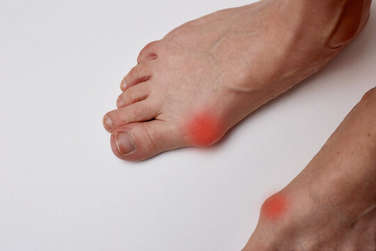 Hallux valgus deformity of the foot on the girl's leg requires treatment