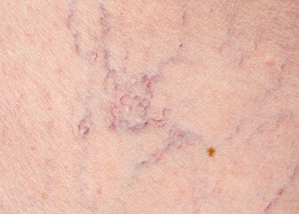 Vascular diseases. Varicose veins. Varicose veins of small vessels on the skin of a woman's thigh.Leg skin repair and treatment concept for elderly and aged people. 