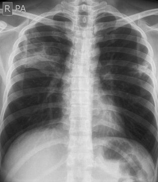 chest x-ray image of  lung abscess