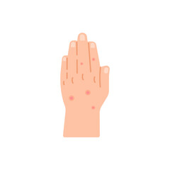 illustration of a hand suffering from skin disease, hives, chickenpox. pain, itching, disease, health problems. flat cartoon. element design