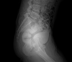 X-ray image of rectovesical fistula A barium enema contrast study reveals contrasts on the rectum and bladder.
