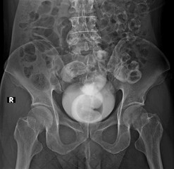 X-ray image of rectovesical fistula A barium enema contrast study reveals contrasts on the rectum...