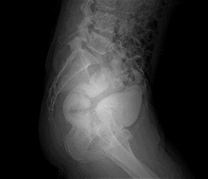 X-ray image of rectovesical fistula A barium enema contrast study reveals contrasts on the rectum and bladder.