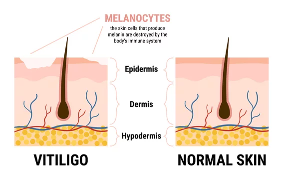 Vitiligo skin disease and healthy skin infographic. Melanocytes stop producing  melanin. Skin anatomy. Flat vector illustration Stock Vector | Adobe Stock