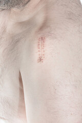 Real scar after an operation for a broken humerus of the upper arm.