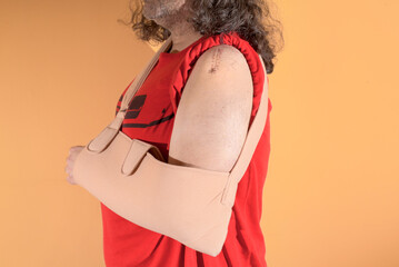 Man with his left arm in a sling and a scar on his shoulder.
