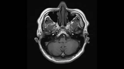 normal  brain anatomy axial t1weighted  MRI images