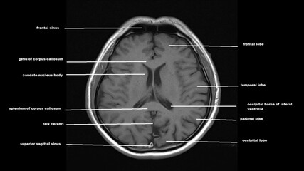 normal  brain anatomy axial t1weighted  MRI images