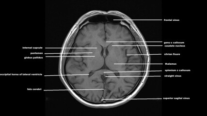 normal  brain anatomy axial t1weighted  MRI images