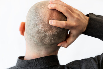 A man in a black shirt is holding his bald head covered with seborrheic dermatitis and dandruff....