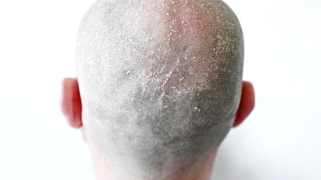 Male bald flaky head with dandruff and seborrheic dermatitis close-up. Back view. White background. The concept of psoriasis and alopecia.
