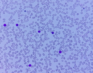Acute lymphoblastic leukemia or Acute leukemia under microscopic examination in medical laboratory