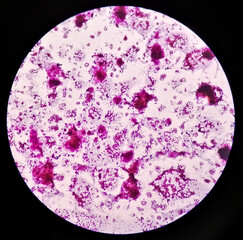 FNAC of male right breast lump under microcopy showing Gynecomastia, enlargement of the male breast which may be hormonal or side effect of certain drugs.