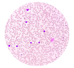 Acute lymphoblastic leukemia or Acute leukemia under microscopic examination in medical laboratory