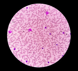 Acute lymphoblastic leukemia or Acute leukemia under microscopic examination in medical laboratory