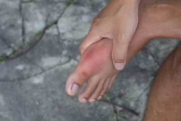 A man's hand catch on his feet that is painful swollen, red due to inflammation from gout.