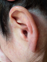 Fototapeta premium flaky dry itchy skin inside women's ear
