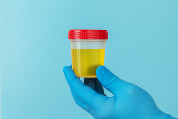 Urine sample for laboratory analysis on urinary infection