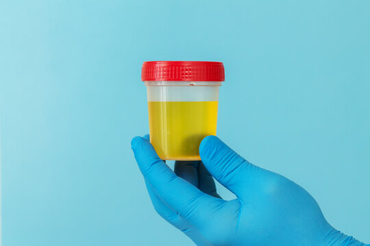 Urine sample for laboratory analysis on urinary infection