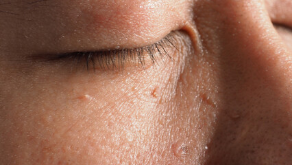 Wart skin removal. Macro shot of warts near eye on face. Papilloma on skin around eye nose and...
