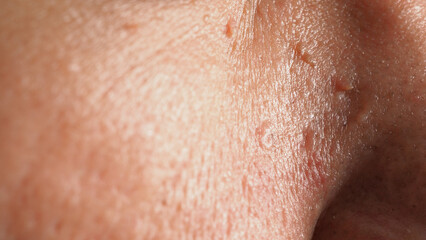 Fototapeta premium Wart skin removal. Macro shot of warts near eye on face. Papilloma on skin around eye nose and neck. Birthmark Papilla or mole on skin. small hard. benign growth on the skin caused by virus. Skincare