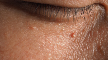 Fototapeta premium Wart skin removal. Macro shot of warts near eye on face. Papilloma on skin around eye nose and neck. Birthmark Papilla or mole on skin. small hard. benign growth on the skin caused by virus. Skincare
