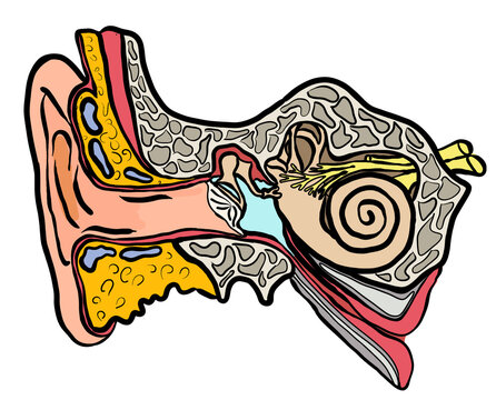 anatomische Sicht auf ein Ohr mit Paukenerguss hinter dem Trommelfell