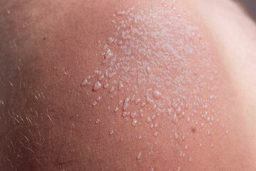 fresh sunburn on a man's shoulder. use uv protection