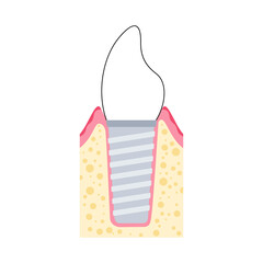 Dental implant procedure