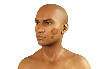 Microsporum canis fungal infection, 3D illustration