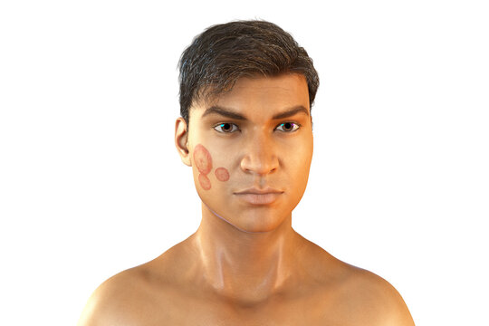 Fungal infection on a man's face, 3D illustration