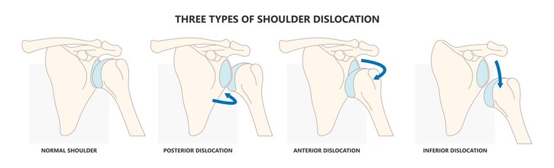 Shoulder dislocation X-ray joint arm sport lesion slap hill sachs tear torn traumatic pain broken cuff sling bone falls tendon subluxed head range of motion Superior overuse clavicle separated therapy